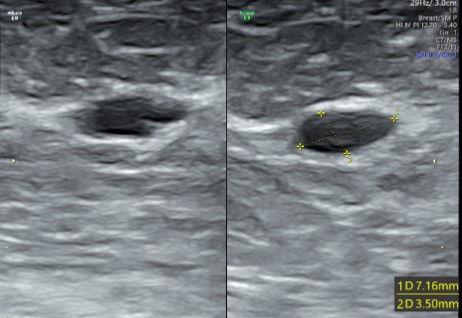 Breast Single side (Sonomammography)