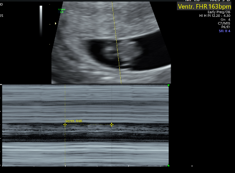 Early Pregnancy with TVS