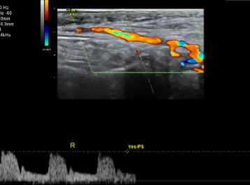 Doppler Temporal Arteries.