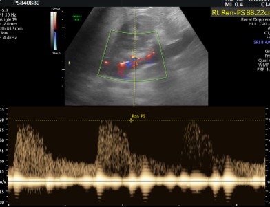 Doppler Renal