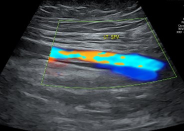 Doppler scan of iliac/ pelvic vessels