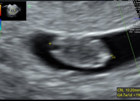 Early Anomaly Scan