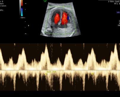 Doppler Obs. + Biophysical Scoring (Twins)