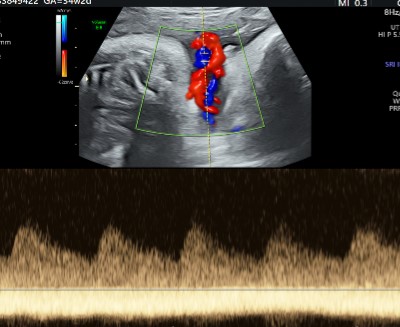 Doppler Obs. + Biophysical Scoring (Triplet)