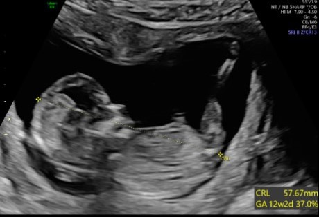 Obstetric + NT & NB With Colour Doppler (Triplet)