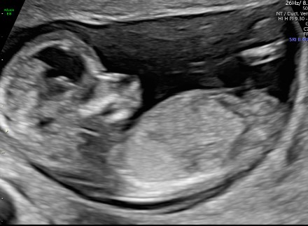 Obstetric + NT & NB With Colour Doppler