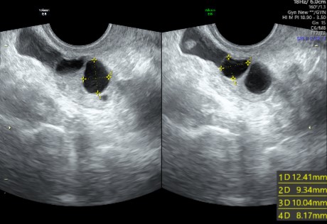 Follicular Study / Ovulation study Single Day