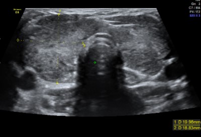 Doppler Liver Abdominal