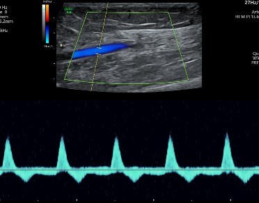 Doppler Both Limb Arterial