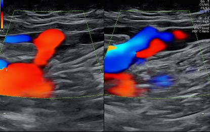Doppler All  Four Limbs Venous
