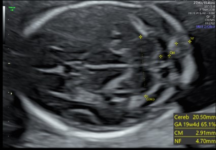 Foetal Neurosonogram