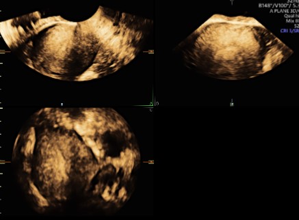 Doppler Gynae (ET,uterus,Ovaries)