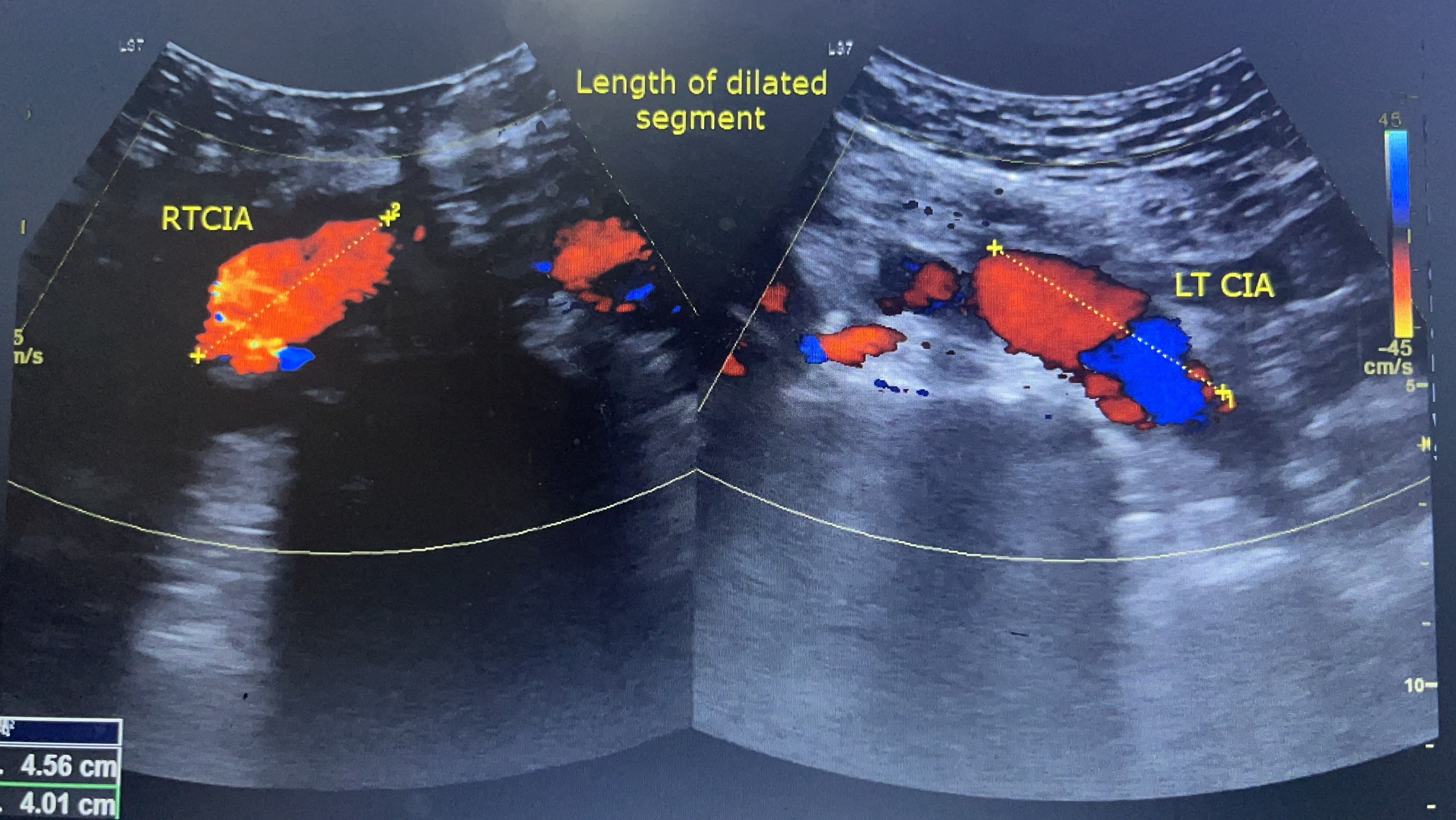Doppler Abdominal Aorta