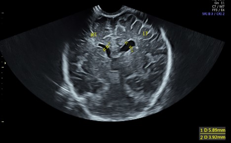 Doppler Liver Abdominal