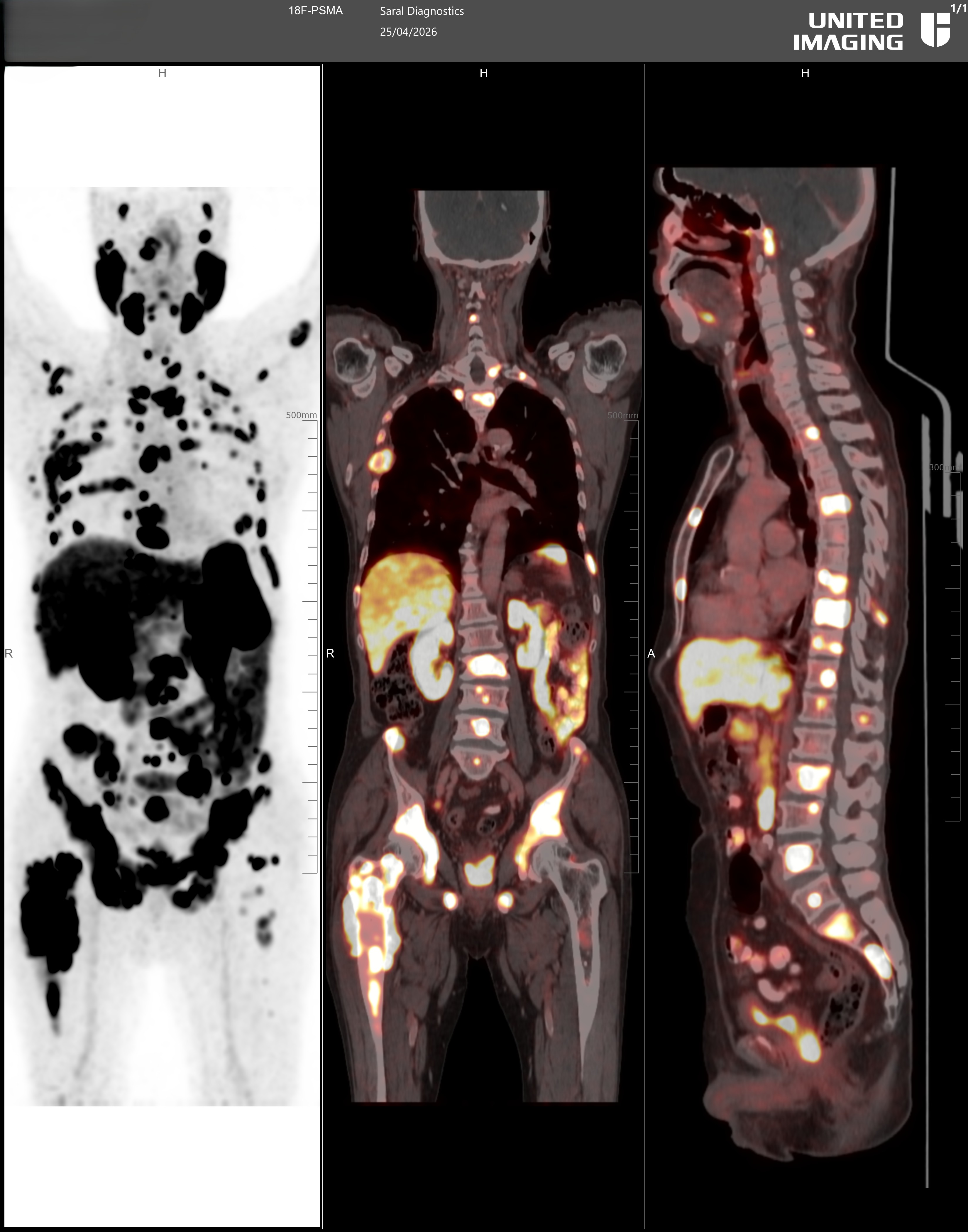 Whole Body F18-PSMA PET CT