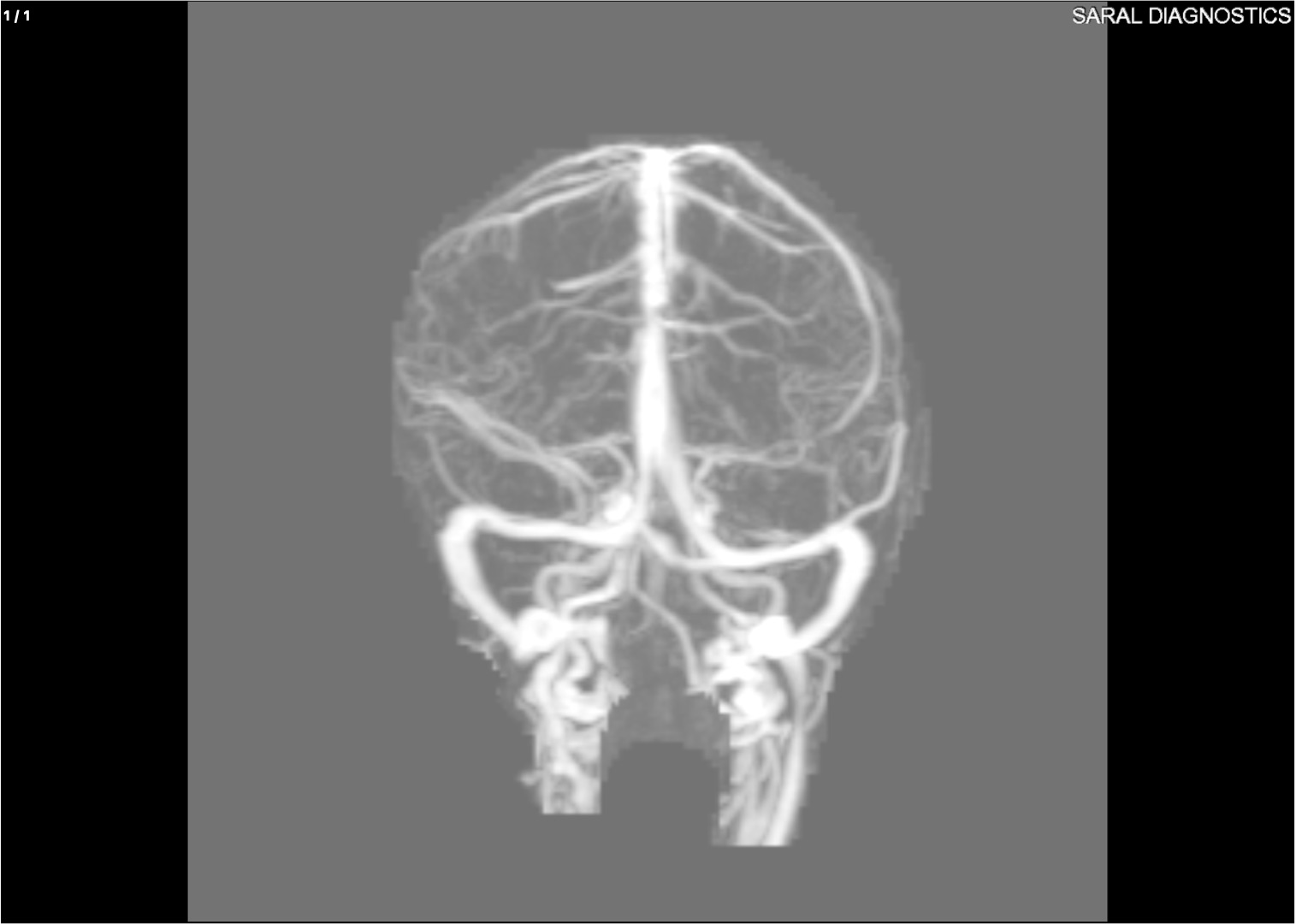 Brain MRV + MRA