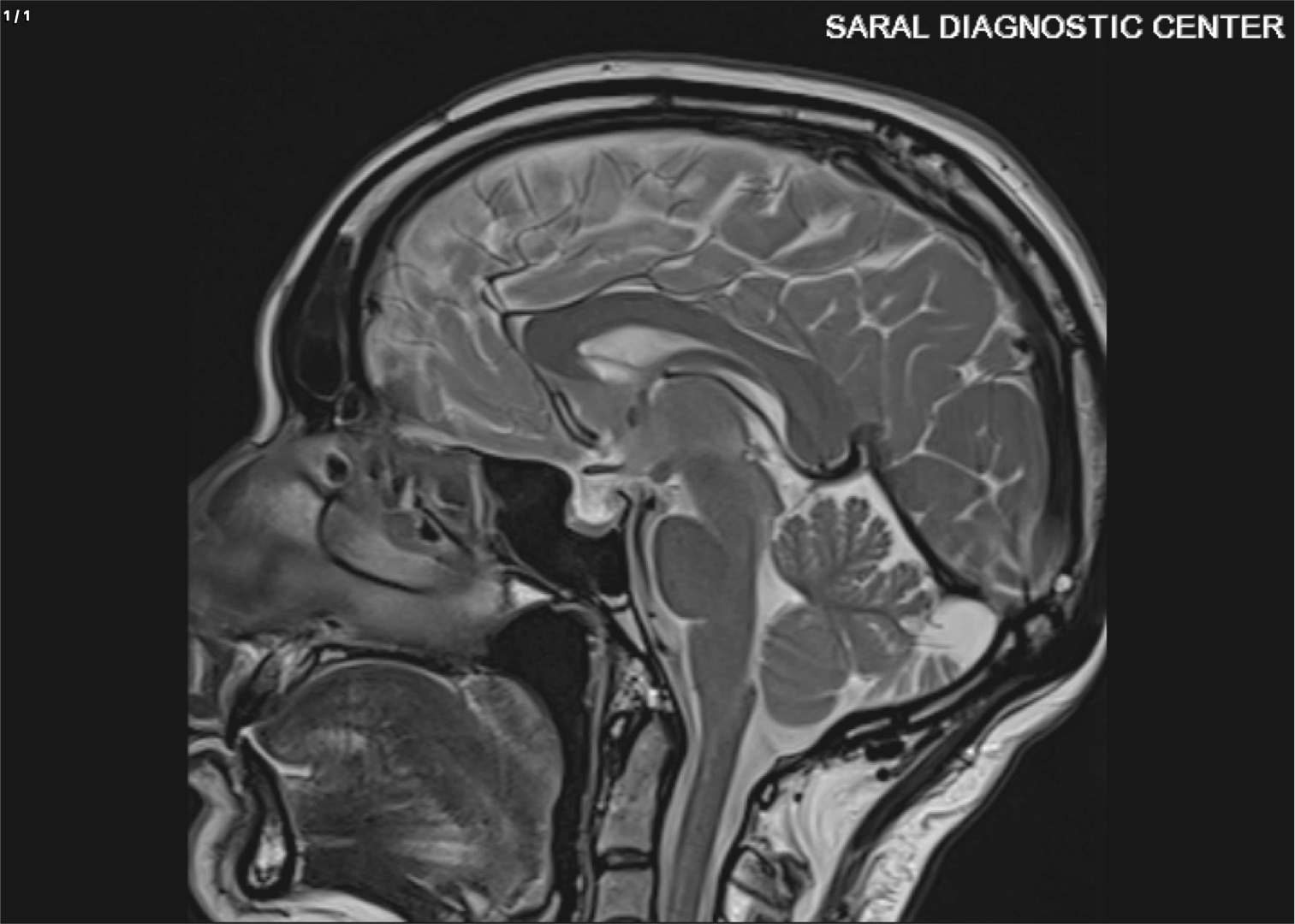 BRAIN WITH PITUITARY / SELLA TURCICA