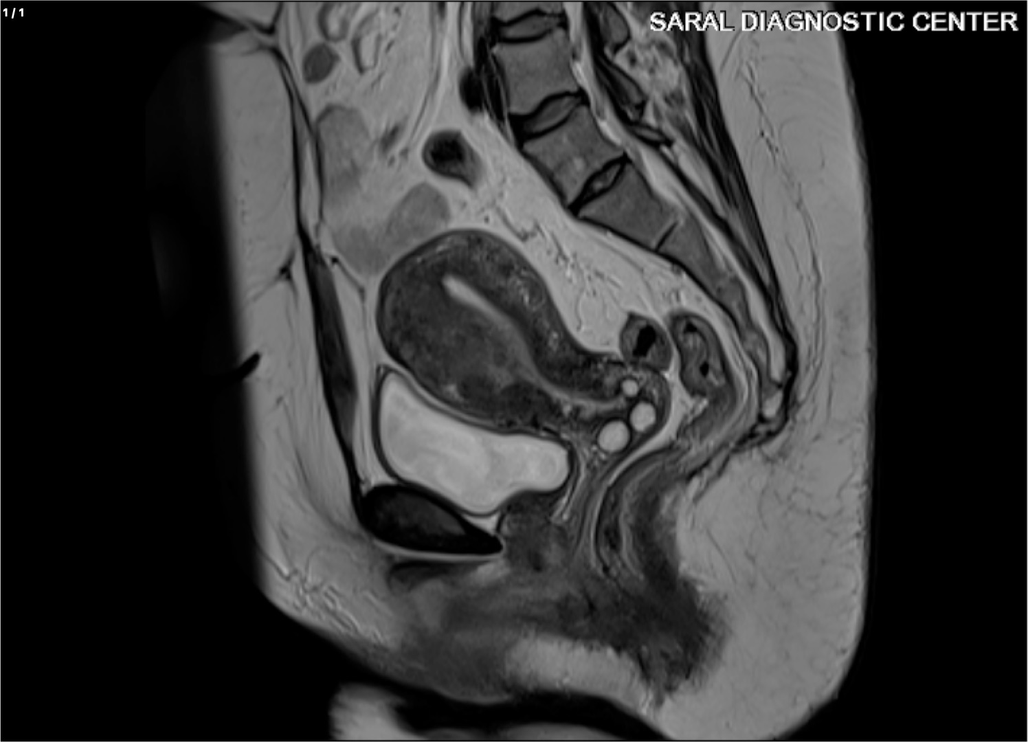 ABDOMEN LOWER / PELVIS WITH CONTRAST