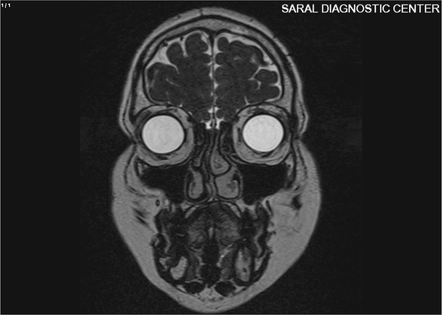 CSF RHINORRHEA/OTORRHOEA/CISTERNOGRAPHY