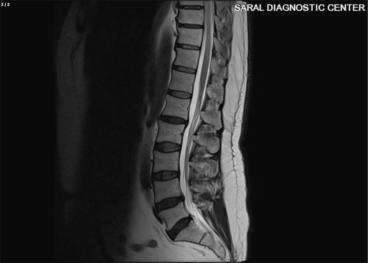 Dorso-Lumbar Spine with contrast