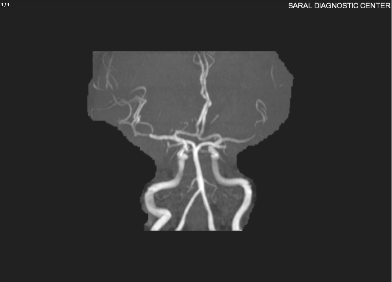 Angio Brain With Contrast