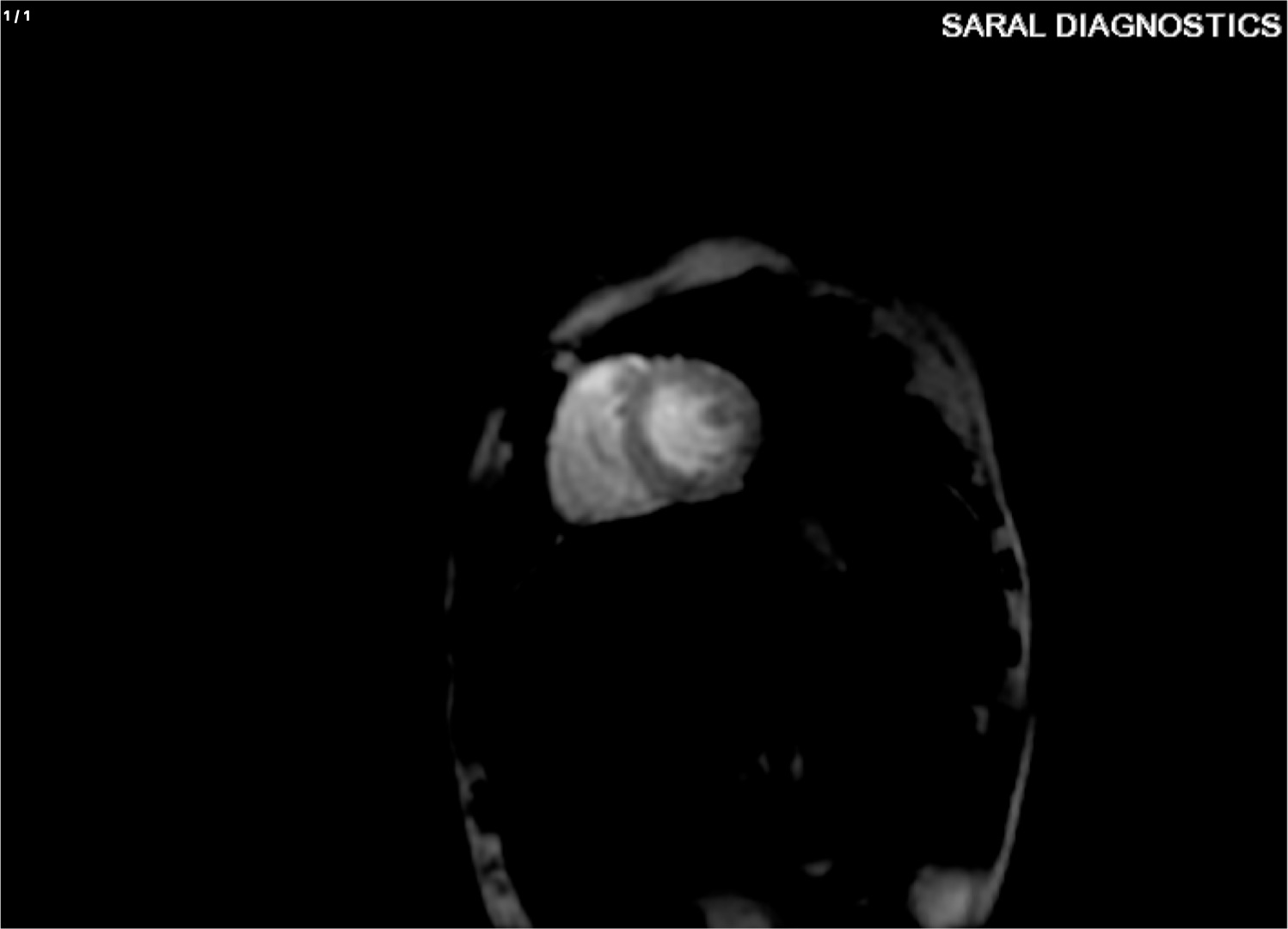 Iron Quantification Heart