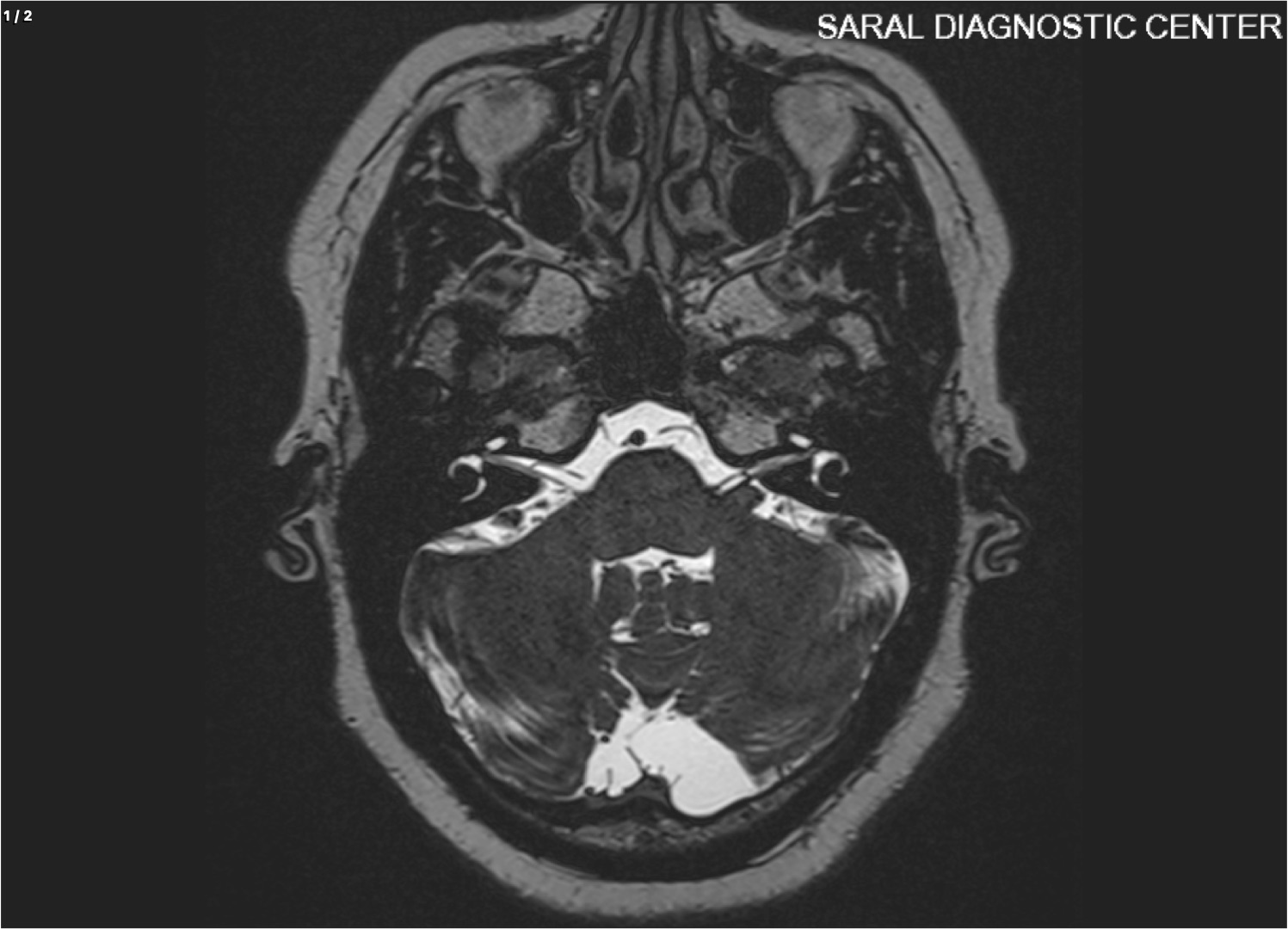 BRAIN WITH CP ANGLE / IAC