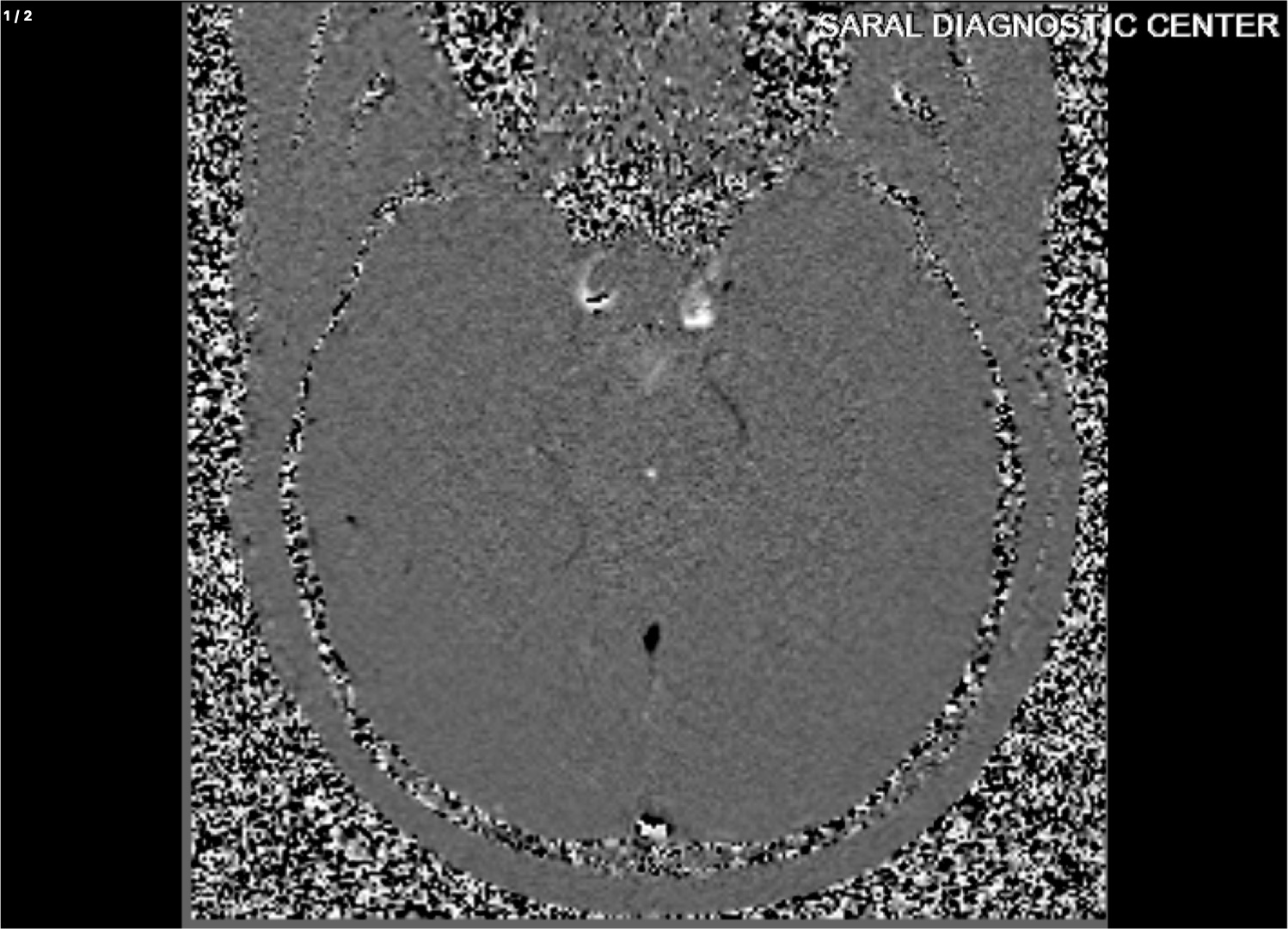 BRAIN WITH CSF FLOW STUDY