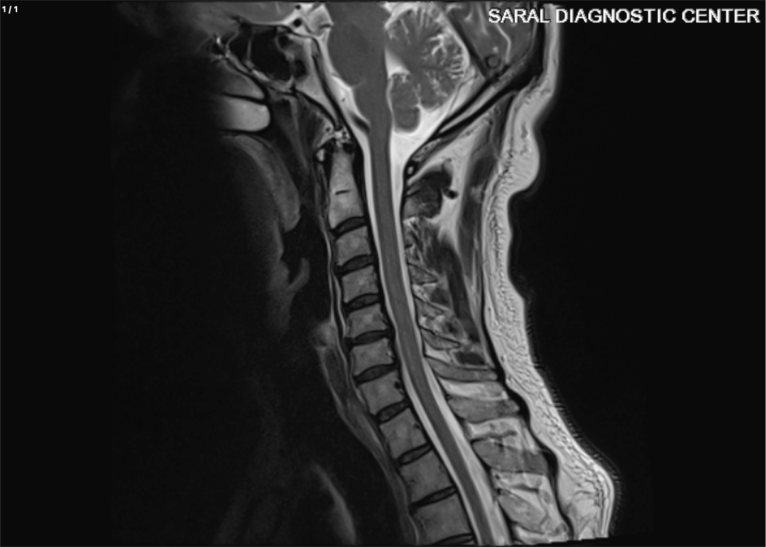 CERVICAL SPINE