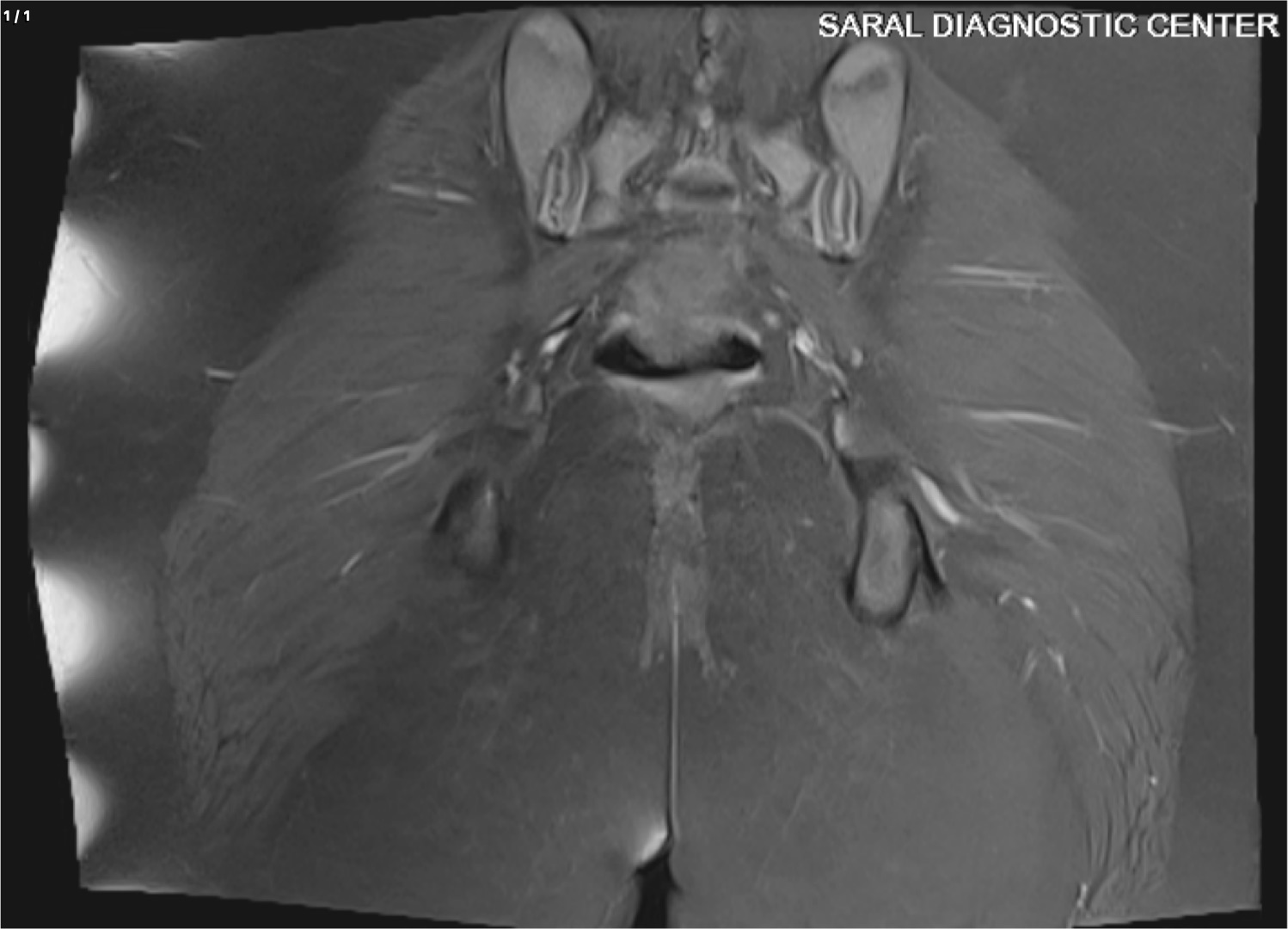 Gluteal region