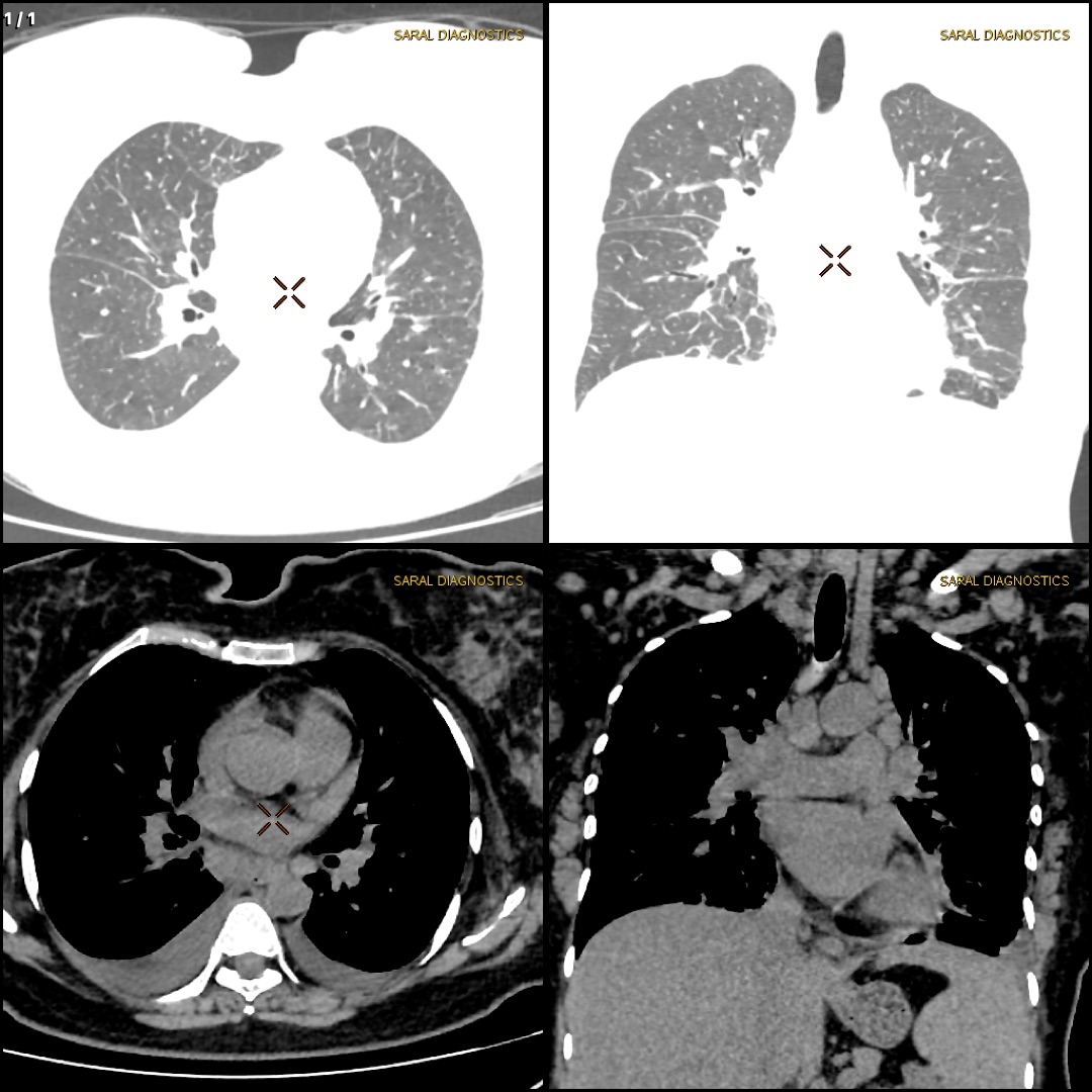 HRCT Chest + CT Chest  (Plain)