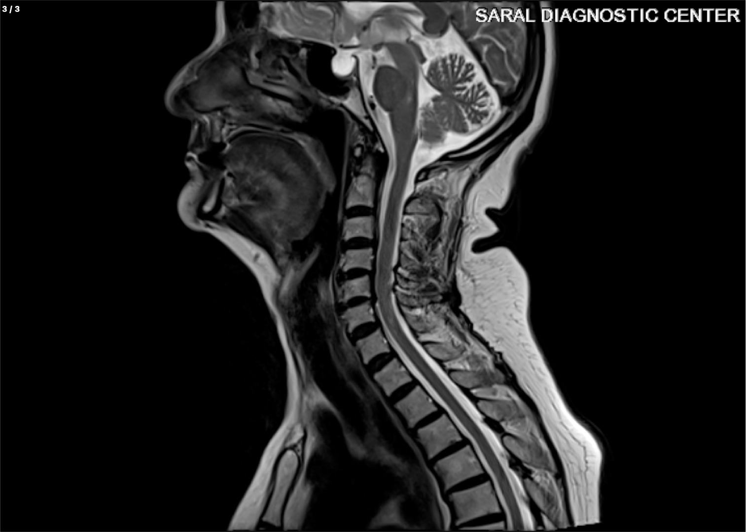 Cervico - Dorsal Spine With Contrast