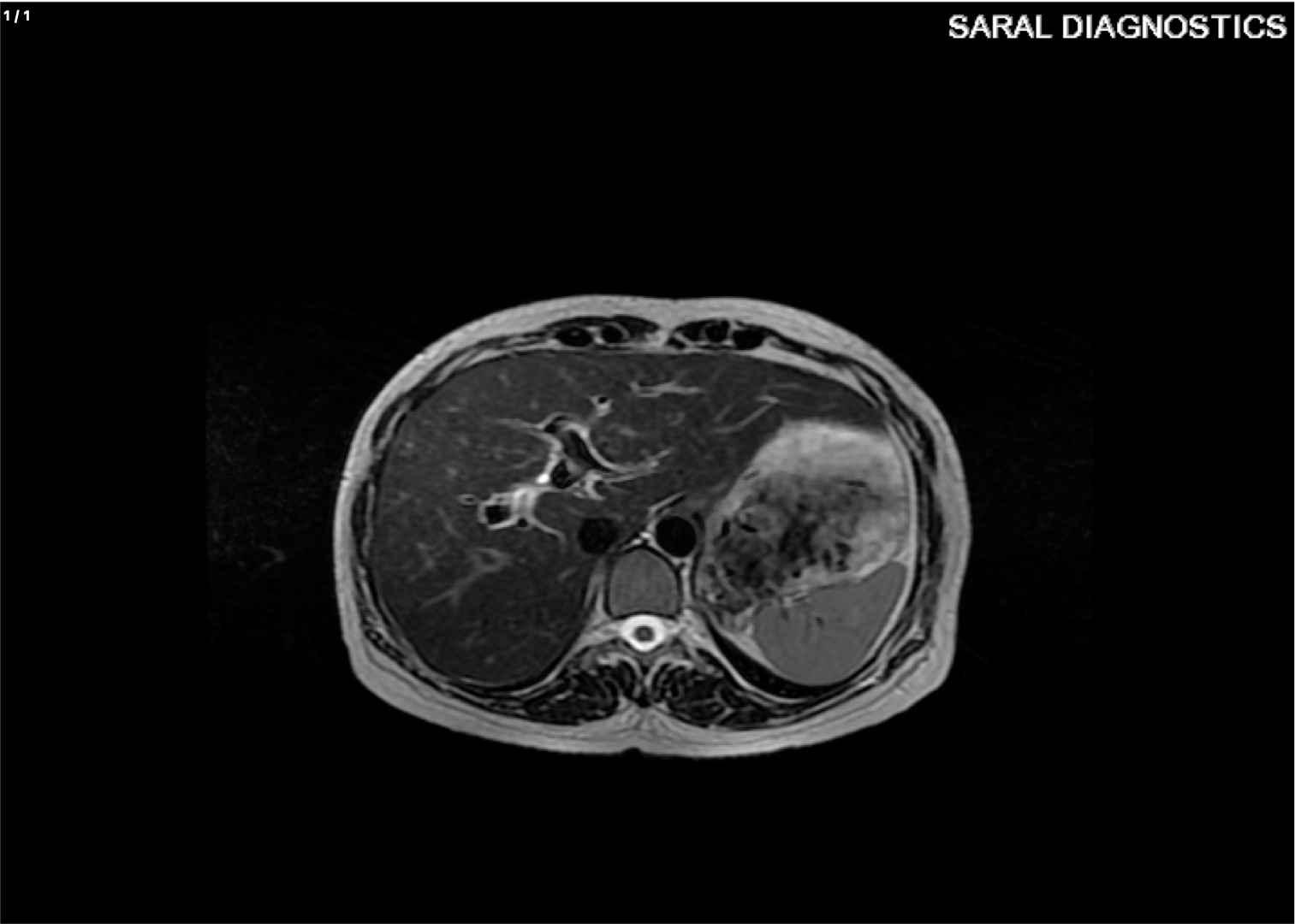 Fat Quantification/PDFF For Liver / Liver Lab
