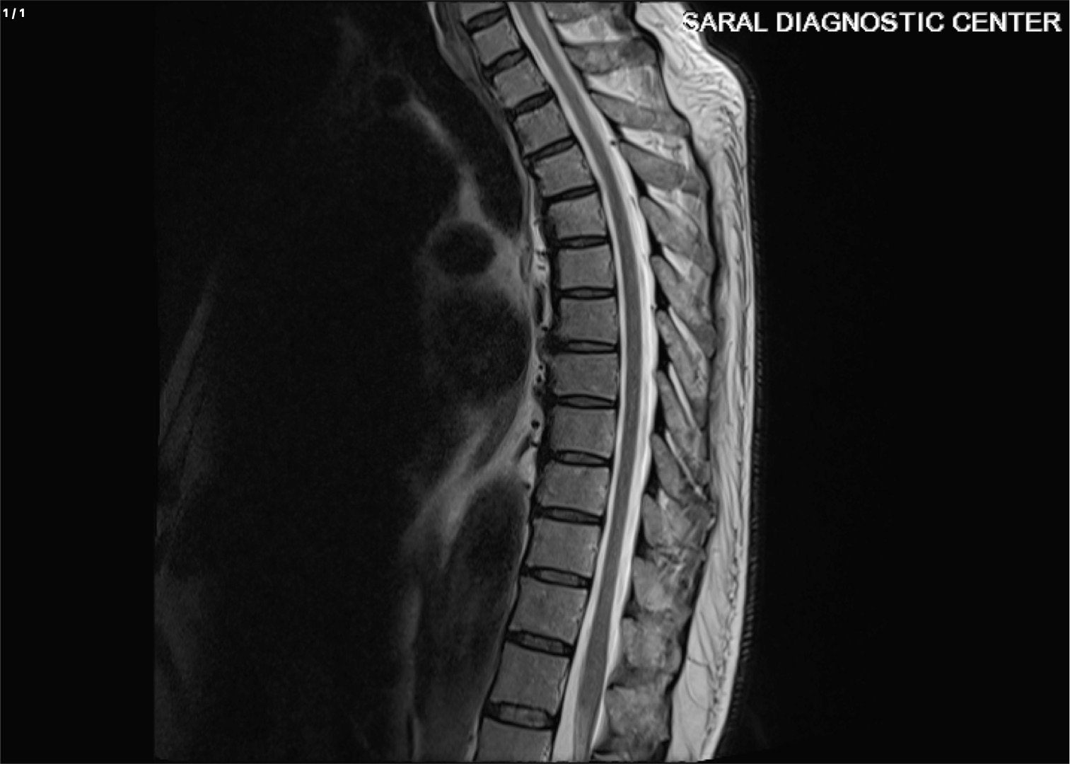 Dorsal Spine / Thoracic Spine Contrast