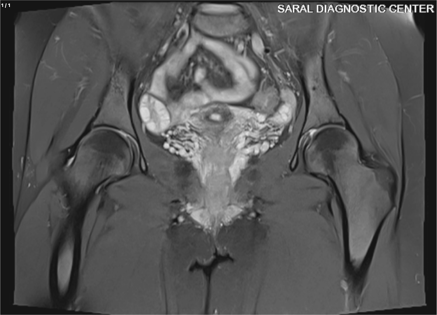 HIP JOINTS (PLAIN)
