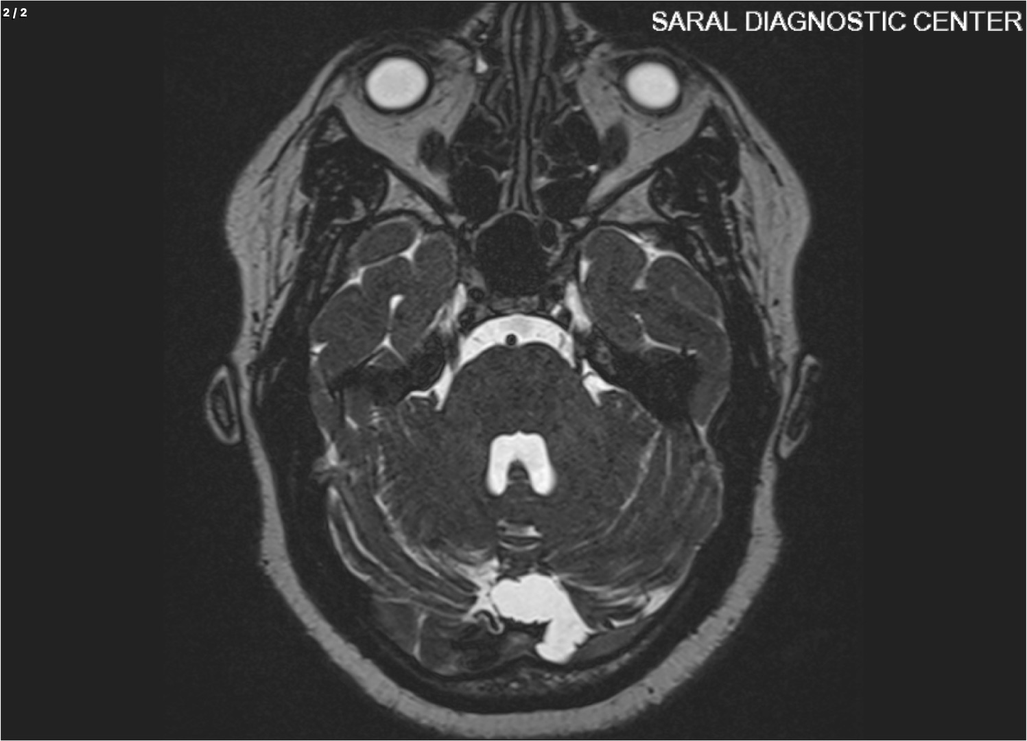 BRAIN HEMIFASCIAL SPASM / TRIGEMINAL NEURALGIA / Glosso Pharyngeal Neuralgia
