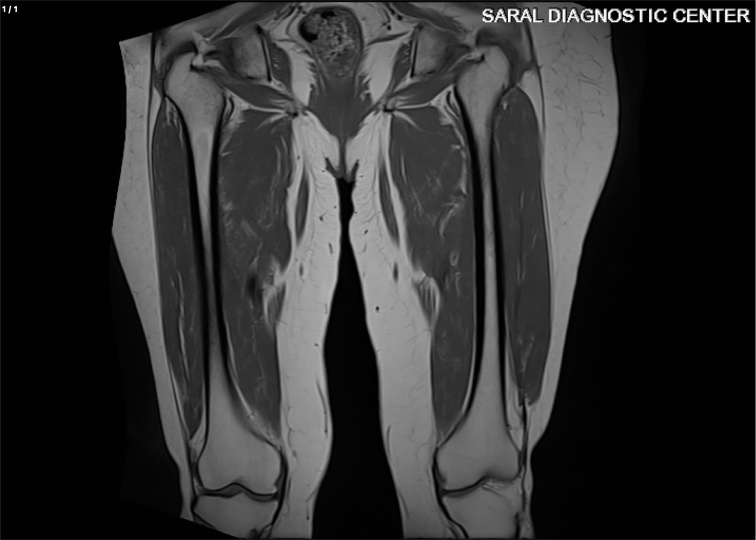 Both Thigh with Contrast