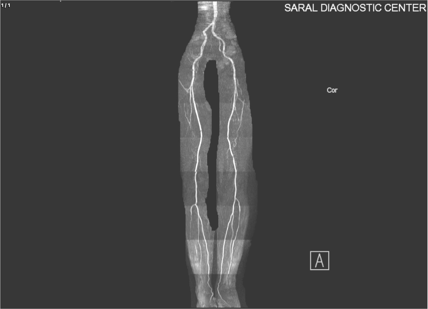 Angio Both Lower Limbs with contrast