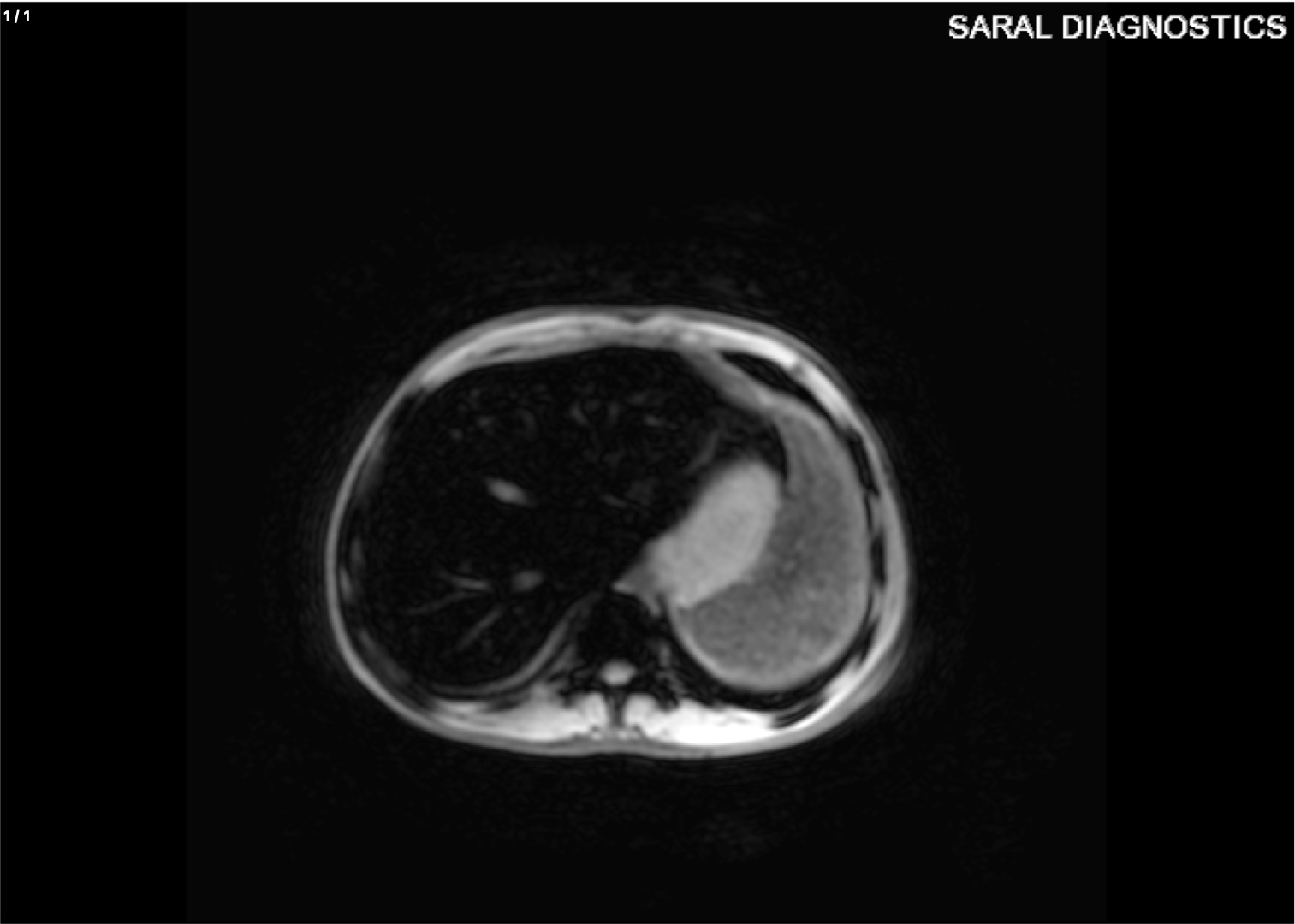 Iron quantification Liver