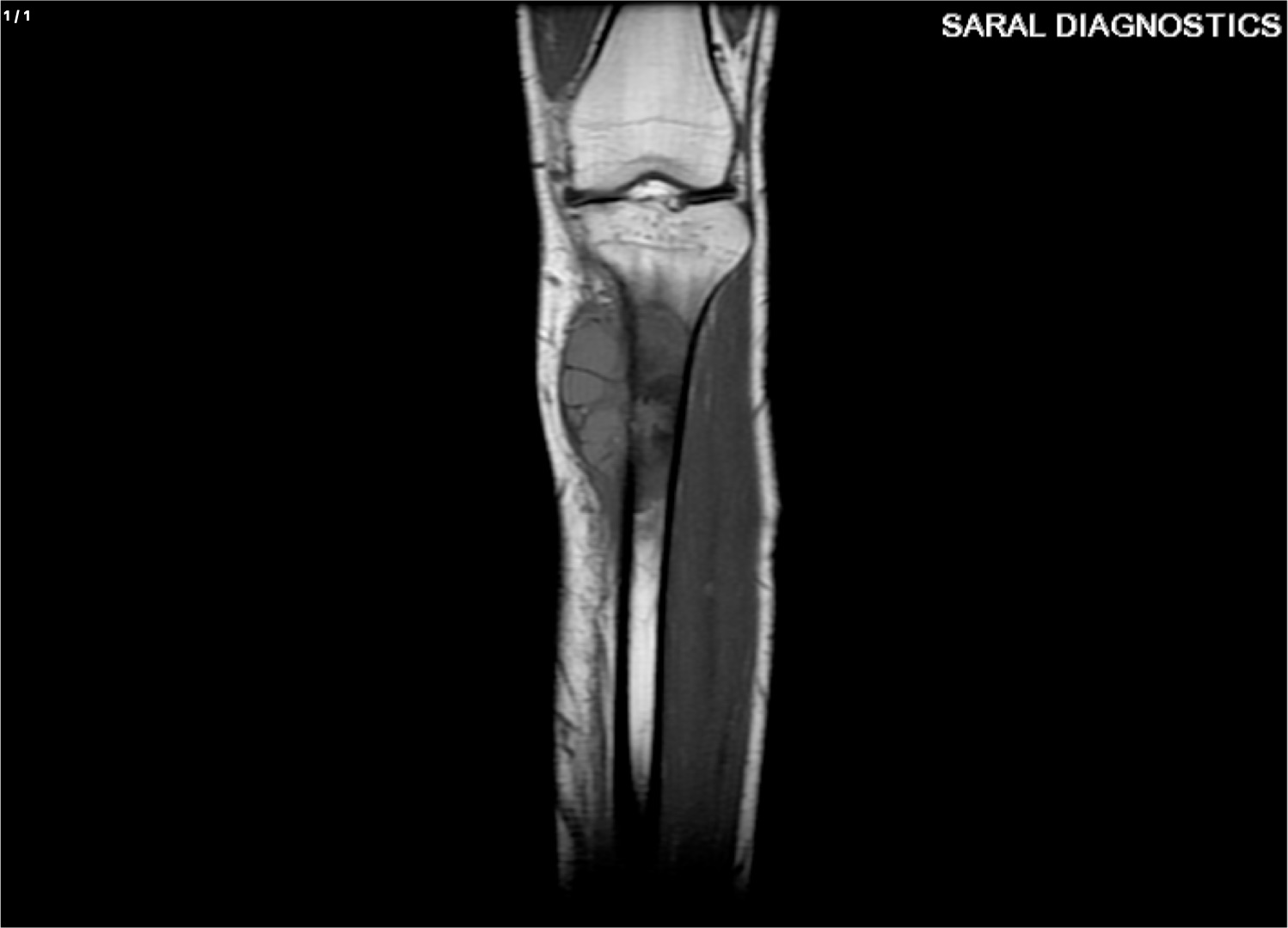 Knee Right with Upper Leg
