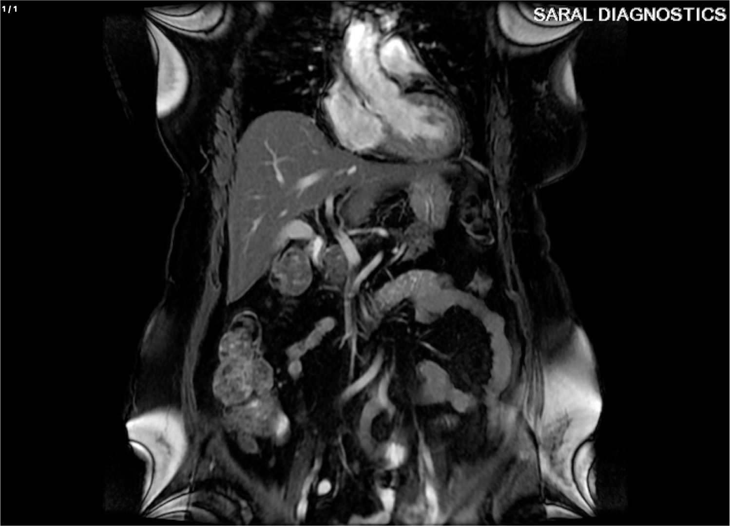 Abdominal wall