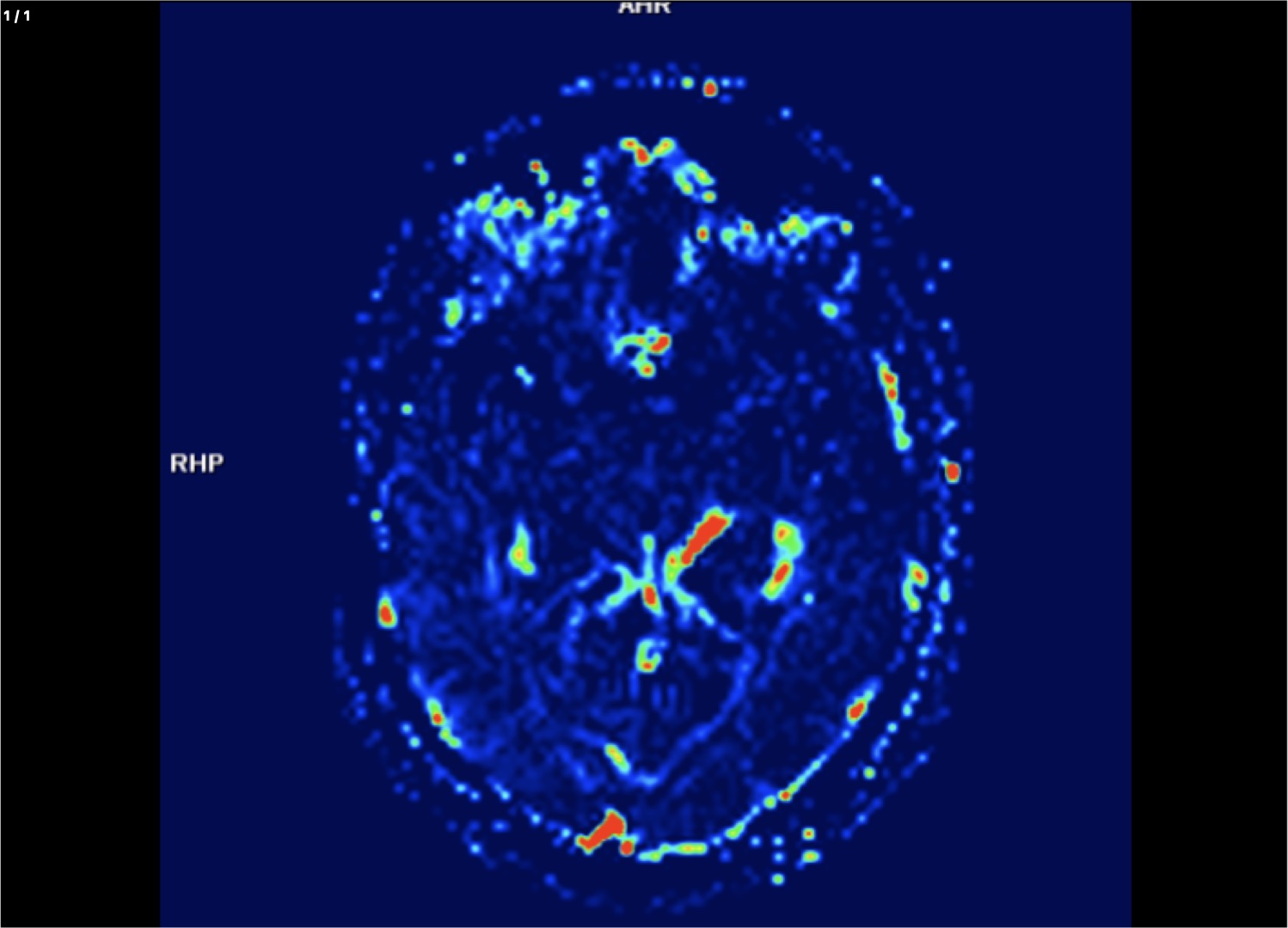 BRAIN + PERFUSION