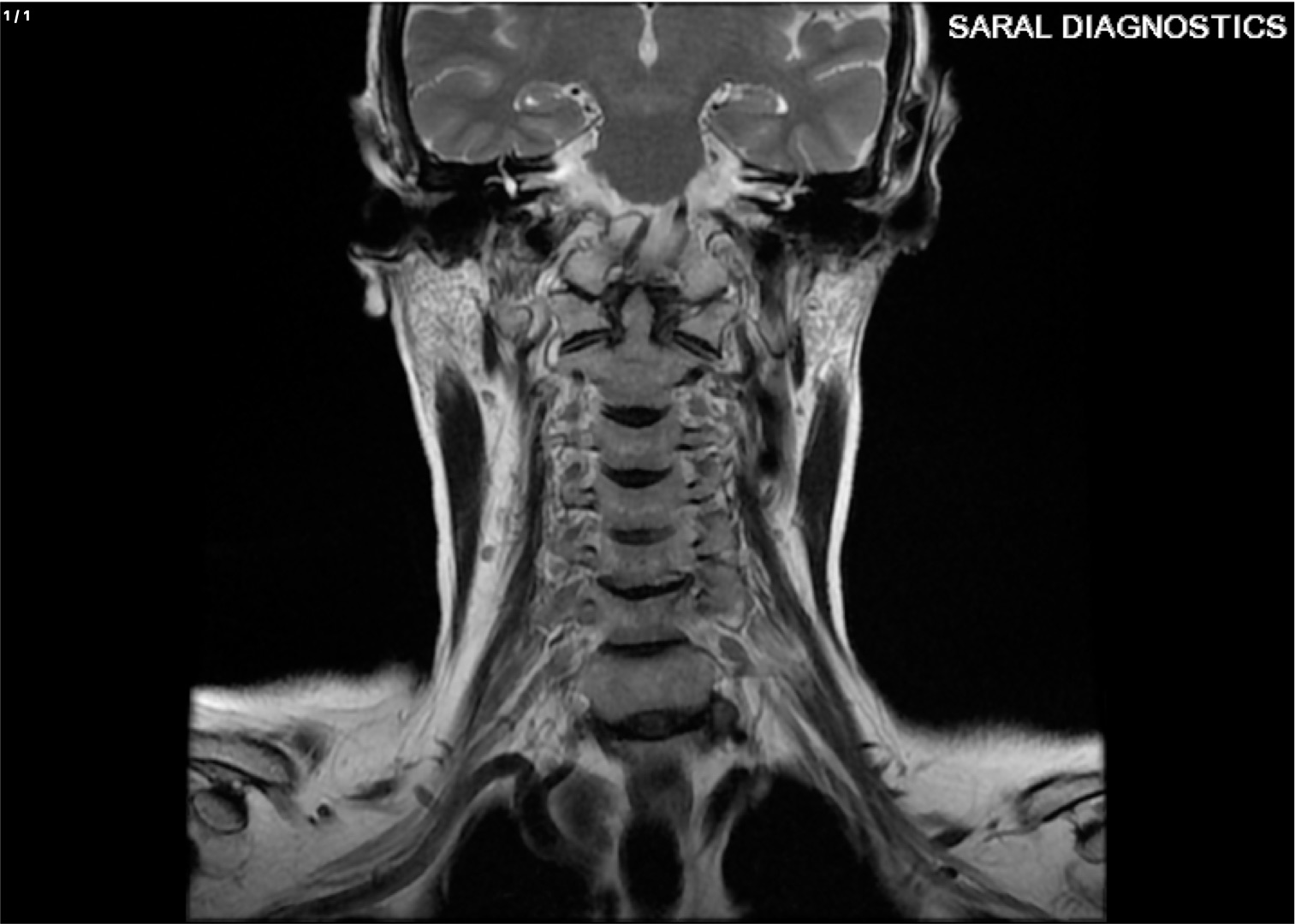 BRAIN WITH CV JUNCTION
