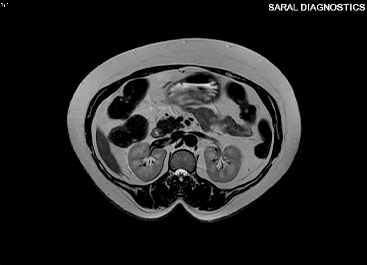 Both Kidney