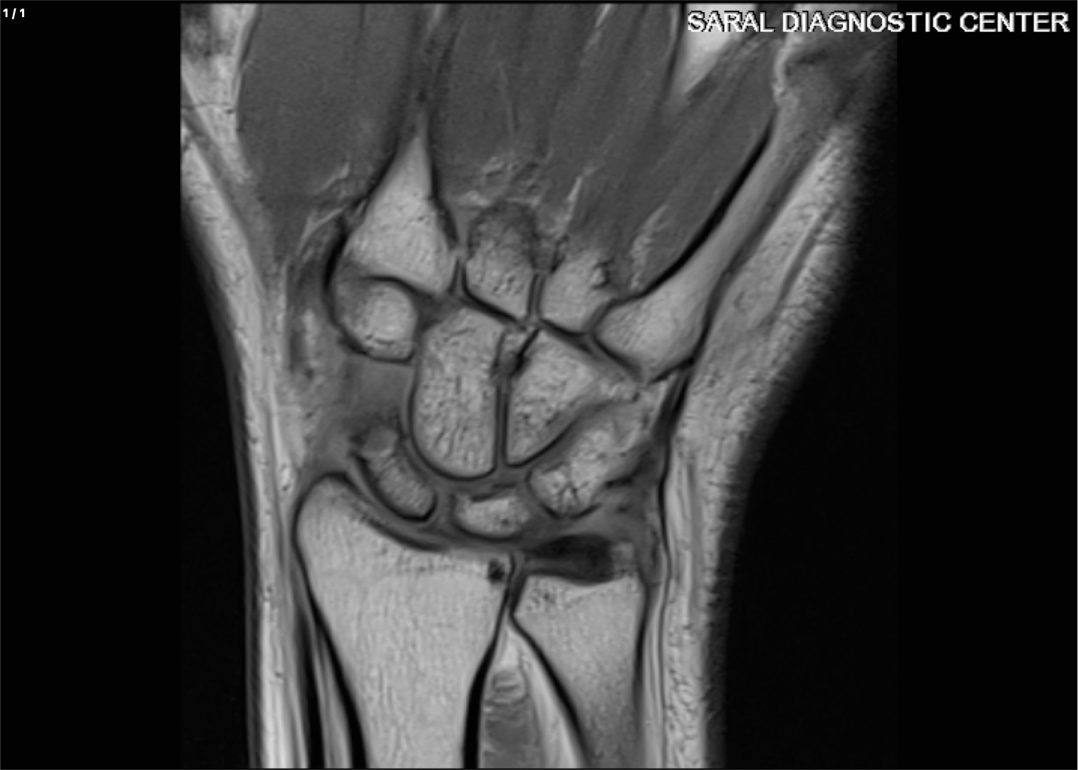 Arthrography Right Wrist (Only Scan charges Exclude Contrast and Surgeon Fee)