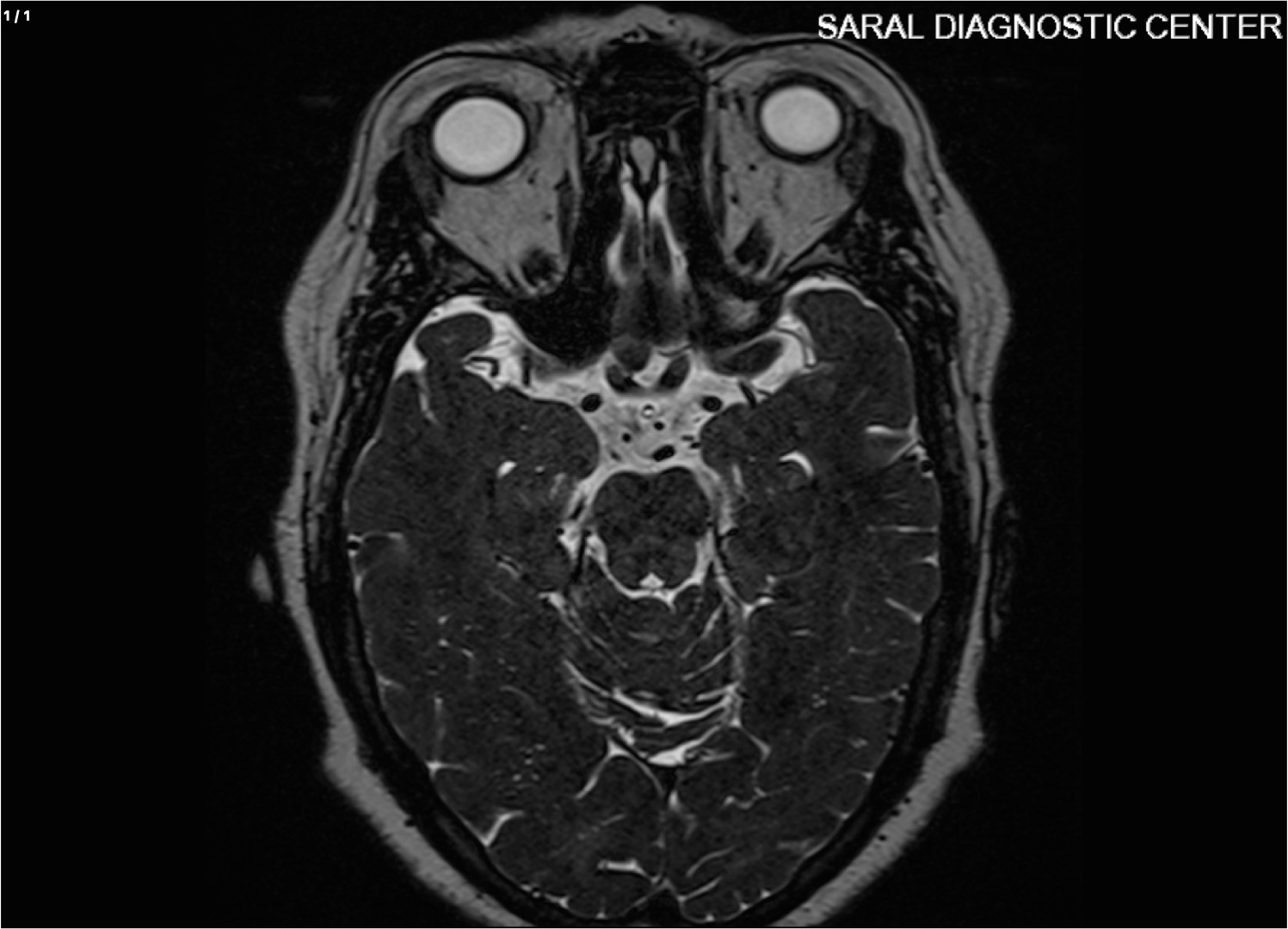 Brain with temporal bone