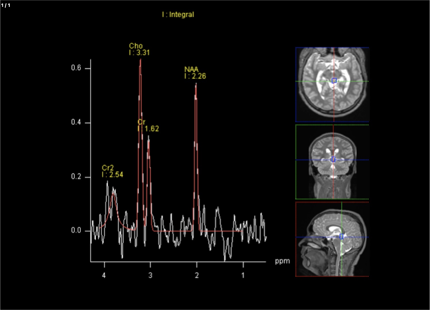 Brain Spectroscopy