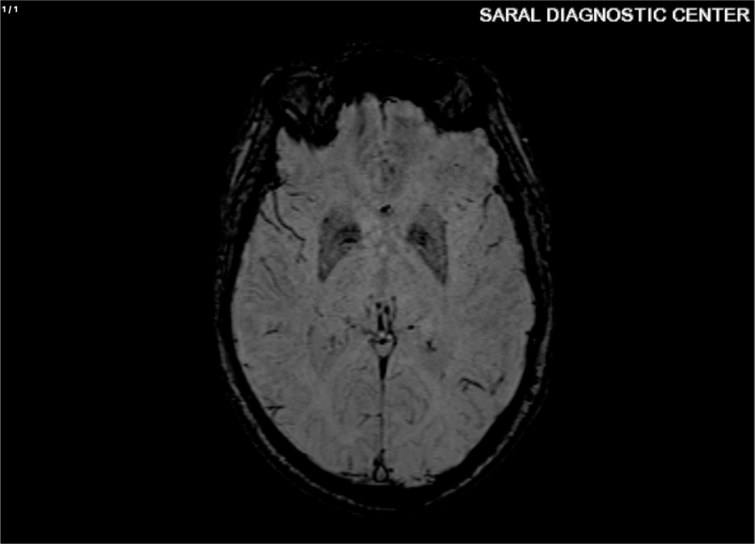 BRAIN WITH PD PROTOCOL