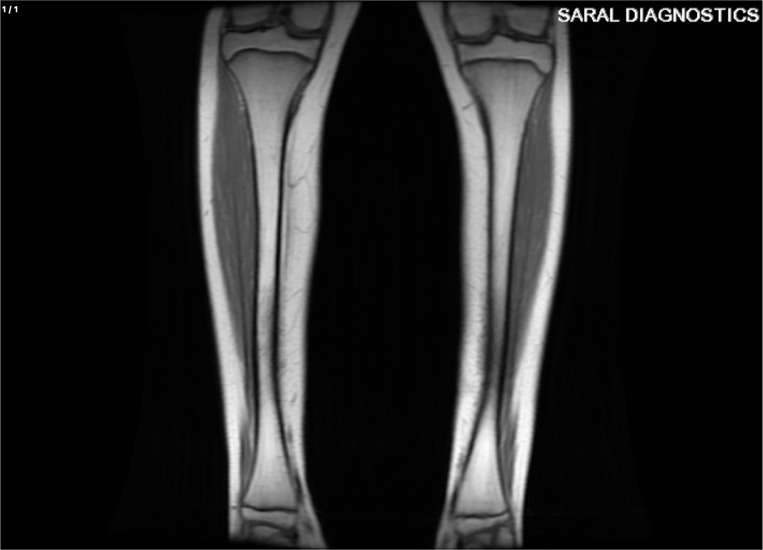 Leg - Right