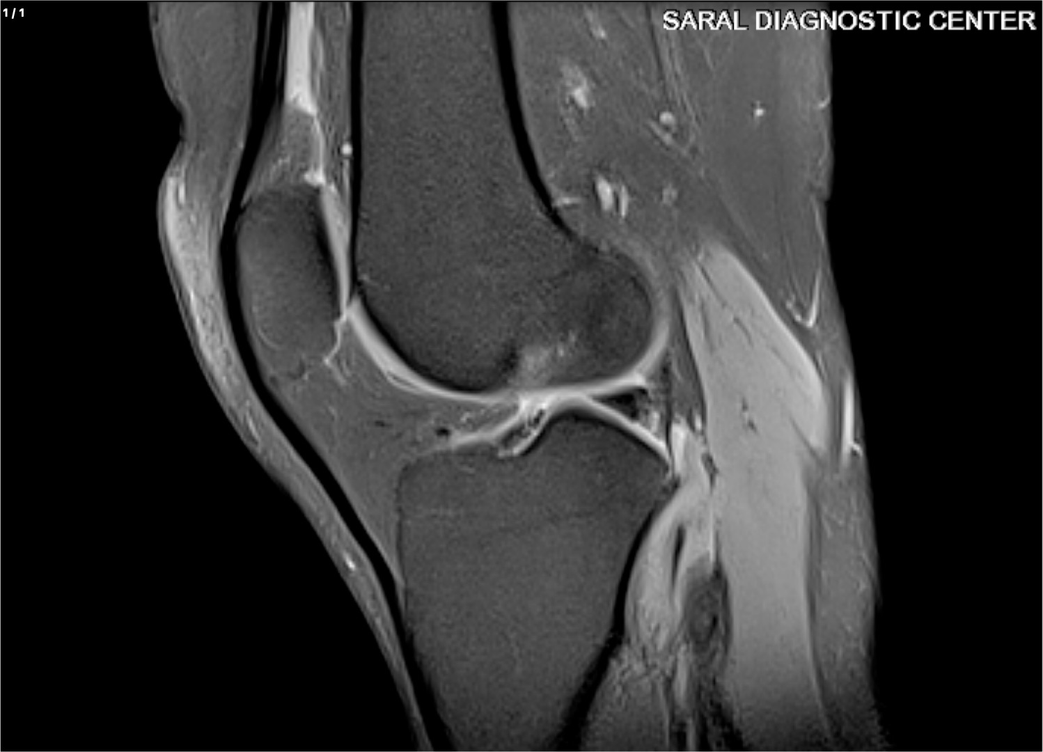 Knee Joint (Rt)  Contrast